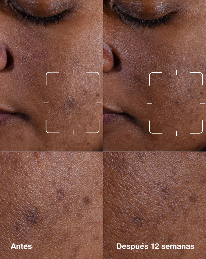 Sérum Facial Unificador Even Better Dark Spot De Clinique Para Todo Tipo De Piel